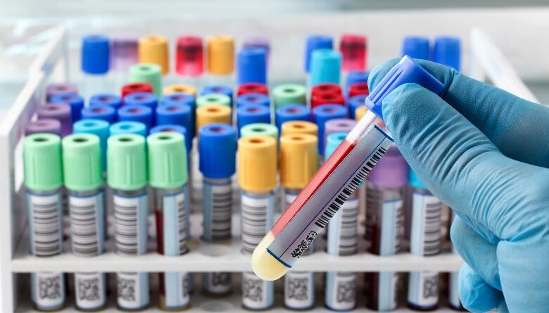 Monocitos Altos en Sangre: Causas, Síntomas y Tratamientos Efectivos para la Salud