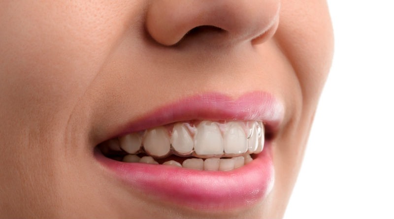 Descubre todo sobre la ortodoncia invisible Invisalign: Beneficios y cuidados esenciales